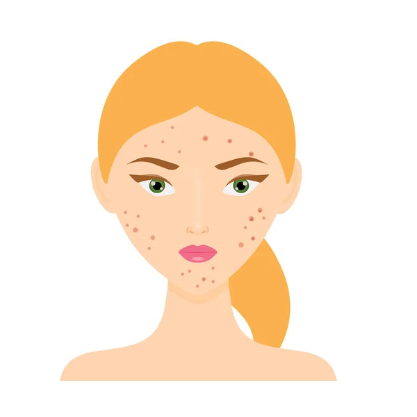 Donna con acne faccia problema della pelle. Illustrazione vettoriale — Vettoriale Stock