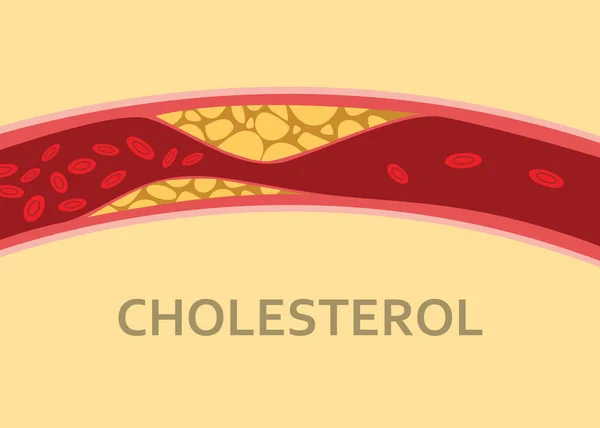 Een menselijk lichaam cholesterol vein met bloedcel stream — Stockvector