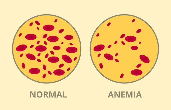 Comparar entre células sanguíneas normais vs anemia doença doente — Vetor de Stock