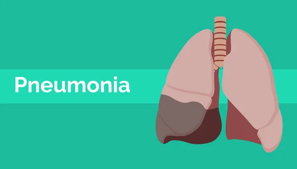 Pulmão com pneumonia doente ou doença de estilo plano —  Vetores de Stock