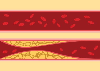 comparison between normal and unhealthy cholesterol human blood vein cell stream flow with fat on side with flat style illustration clipart