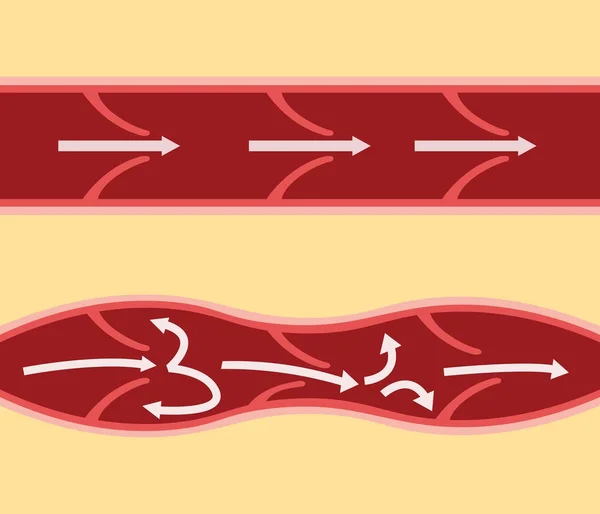 Comparaison comparaison entre la veine normale et la varice dans l'alignement horizontal — Image vectorielle