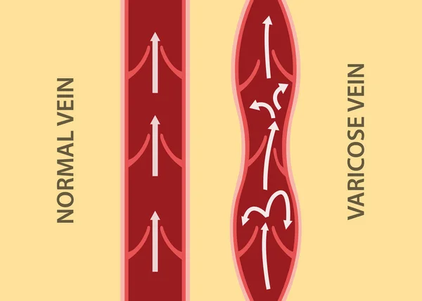 Comparación comparar entre vena normal y vena varicosa en alineación vertical — Vector de stock