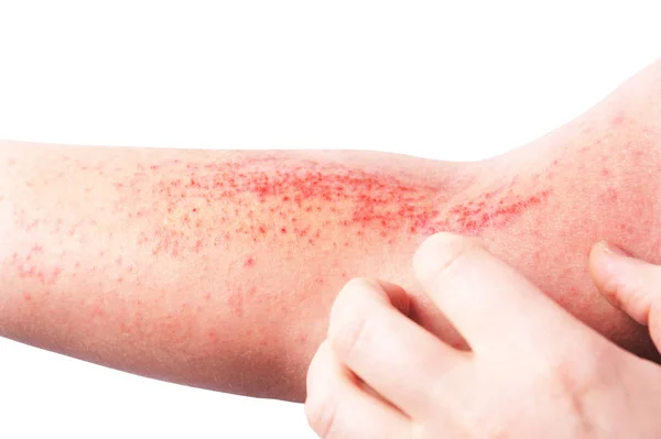 Atopisk Dermatit Även Känd Som Atopiskt Eksem Typ Inflammation Huden — Stockfoto