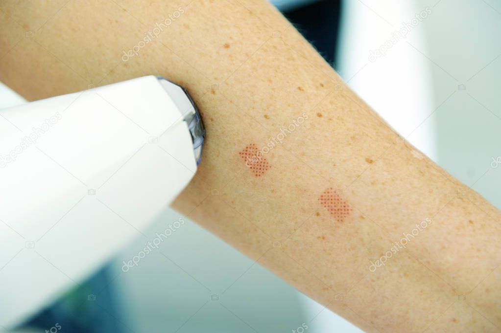 Traces on the arm from after laser therapy