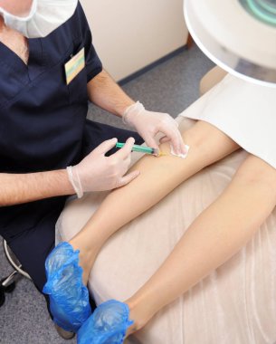 Doktor dizinin altına bir şırınga enjekte ediyor. Bir doktor, kadının bacağındaki varisli damarlara iğne yapar. Yakın plan, skleroterapi, soyunma, flebeurizm, tıbbi....