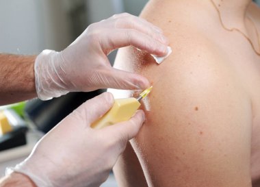 Karbondioksit terapisi (karboksiterapi). Cilt tazeleme. Ameliyat hastaların omuzlarında yapılır..