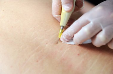 Karbondioksit terapisi (karboksiterapi). Deri yenilenmesi. İşlem hastanın sırtında yapılır..