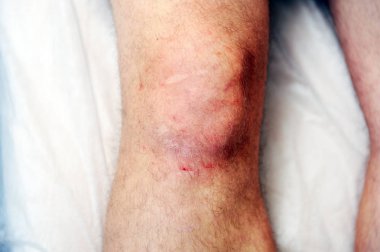 Reddened skin on the knee after carbon dioxide therapy (carboxytherapy) clipart