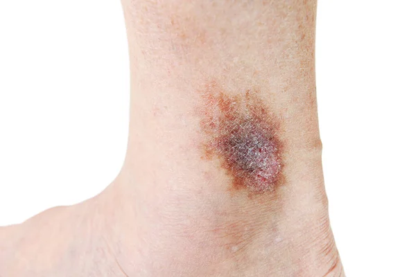 Atopické Dermatitidy Také Známý Jako Atopický Ekzém Druh Zánět Kůže — Stock fotografie