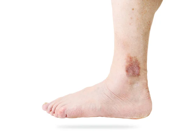 Dermatite Atopique Également Connue Sous Nom Eczéma Atopique Est Type — Photo