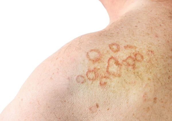 Aopic Dermatitis 어깨에 피부염 일종이다 — 스톡 사진