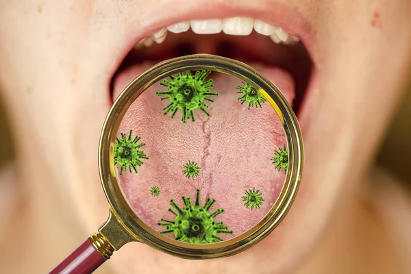 Coronovirus 'un ilk işareti, dilinde beyaz bir plaket, yakın plan.
