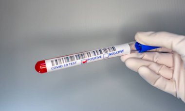 Coronavirus testi pozitif çıkmış bir hastanın test tüpünü taşıyan bir hemşire elinin bulanık görüntüsü.