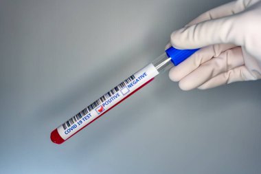 Coronavirus testi pozitif çıkmış bir hastanın test tüpünü taşıyan bir hemşire elinin bulanık görüntüsü.
