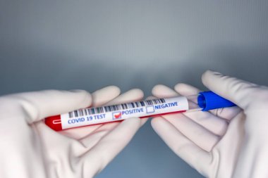 Coronavirus testi pozitif çıkmış bir hastanın test tüpünü taşıyan bir hemşire elinin bulanık görüntüsü.