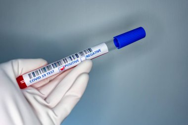Coronavirus testi pozitif çıkmış bir hastanın test tüpünü taşıyan bir hemşire elinin bulanık görüntüsü.