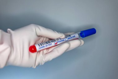 Coronavirus testi pozitif çıkmış bir hastanın test tüpünü taşıyan bir hemşire elinin bulanık görüntüsü.