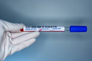 Coronavirus testi pozitif çıkmış bir hastanın test tüpünü taşıyan bir hemşire elinin bulanık görüntüsü.