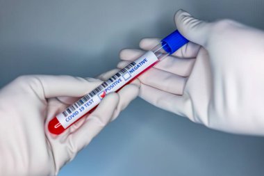 Coronavirus testi pozitif çıkmış bir hastanın test tüpünü taşıyan bir hemşire elinin bulanık görüntüsü.