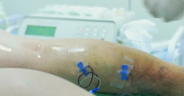 病人的老女人腿: 血栓形成, 蜘蛛静脉, 静脉曲张。操作前 — 图库视频影像