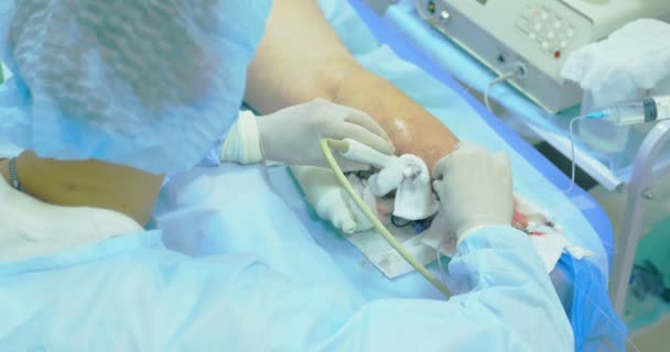 Método innovador de cirugía de venas varicosas, procedimiento de escleroterapia. Primer plano de las piernas del paciente — Vídeo de stock
