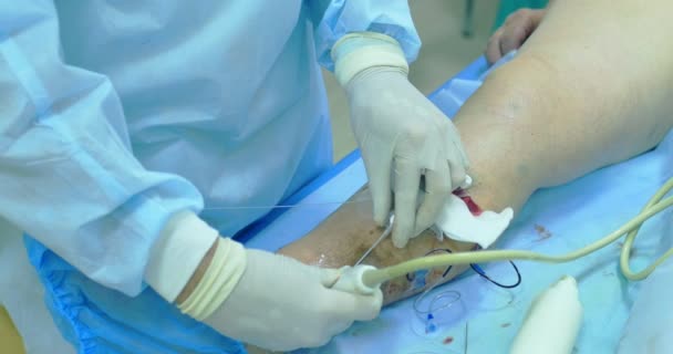 정 맥 류 수술, sclerotherapy 절차의 혁신적인 방법. 환자 다리의 클로즈업 샷 — 비디오
