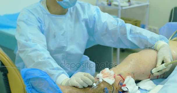 Método innovador de cirugía de venas varicosas, procedimiento de escleroterapia. Primer plano de las piernas del paciente — Vídeos de Stock