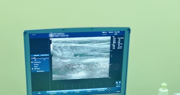 Ultrassonografia moderna para visualizar a veia no procedimento de escleroterapia. Um método inovador de cirurgia de varizes, close-up — Vídeo de Stock