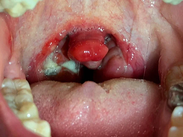 Krónikus Mandulagyulladás Szájüreg Nyálkahártyájának Károsodása Genny Fájó Mandulákon — Stock Fotó