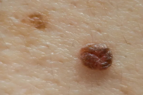 Μακρό Γύρισμα Mole Στο Ανθρώπινο Δέρμα — Φωτογραφία Αρχείου