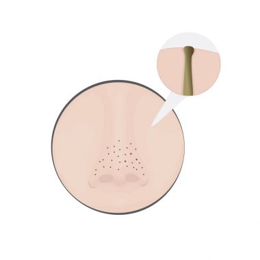 Burun üzerindeki siyah noktaları