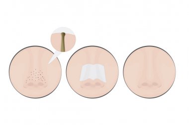 Burun üzerindeki siyah noktaları