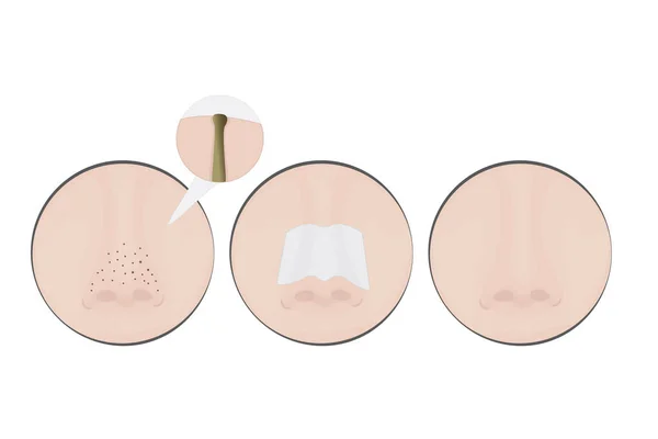 鼻子上的黑头 — 图库矢量图片