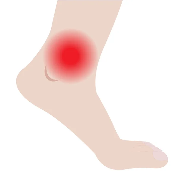 Zwelling van de voeten en enkels door infectie of letsel — Stockvector