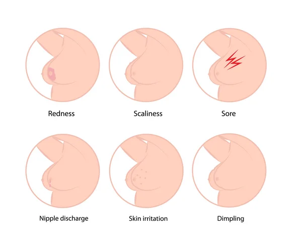 Ранние симптомы рака молочной железы — стоковый вектор