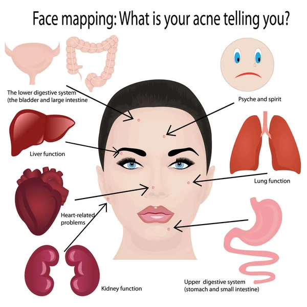 Mapeamento facial. O que sua acne dizendo-lhe info-gráfico —  Vetores de Stock