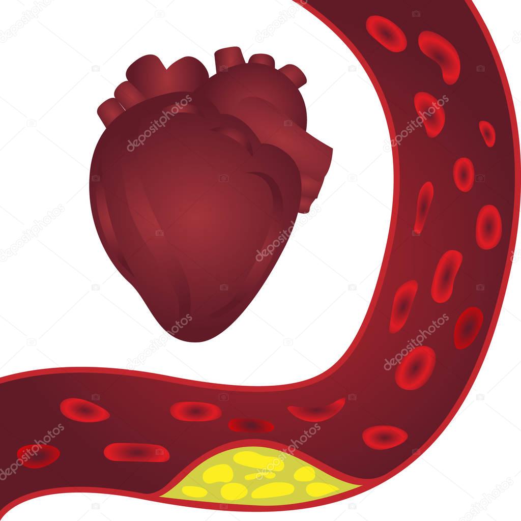 Cholesterol plaque in artery (atherosclerosis) illustration