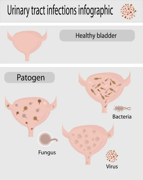 Infektion der Harnwege Infografik — Stockvektor