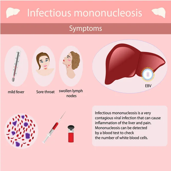 Síntomas de mononucleosis infecciosa . — Vector de stock