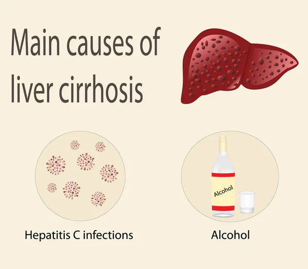 Principales causas de cirrosis hepática — Archivo Imágenes Vectoriales