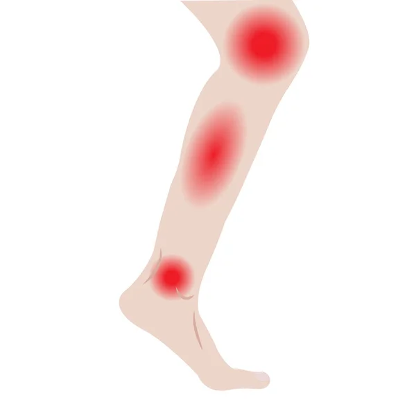 Zwelling van de voeten en enkels door infectie of letsel — Stockvector