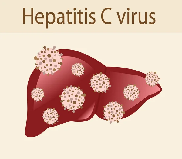 Επίθεση του ιού ηπατίτιδας C στο ήπαρ — Διανυσματικό Αρχείο