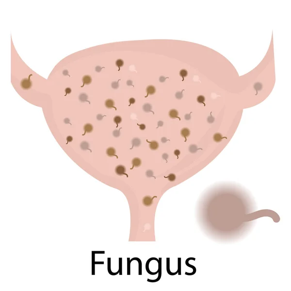 Infezione del tratto urinario. Fungo — Vettoriale Stock