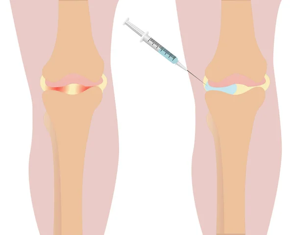 Knä injektion inflammation rodnad vektor illustrationm — Stock vektor