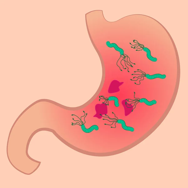 Uno stomaco con Moncler e Helicobacter pylori — Vettoriale Stock
