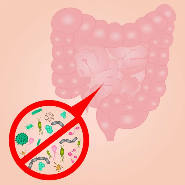 Detener el crecimiento excesivo bacteriano en el signo del intestino delgado — Archivo Imágenes Vectoriales