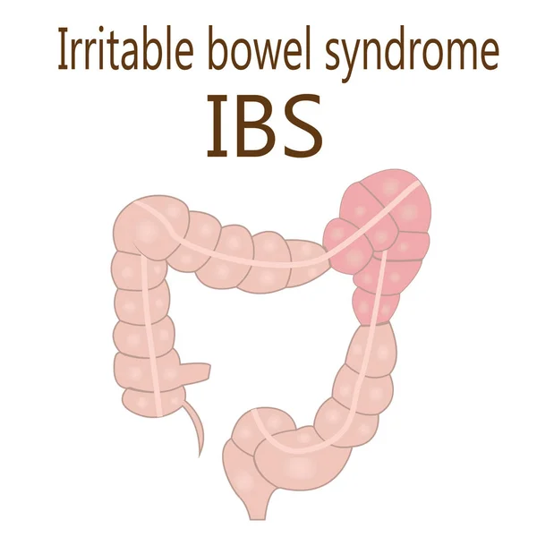 Irritable bowel syndrome (IBS) in a large intestine — Stock Vector