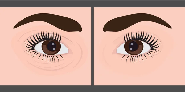 Dark circles under eyes to remove before and after — Stock Vector