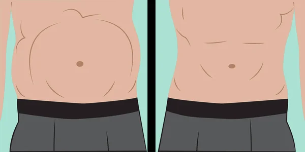 Hinchazón abdominal en el estómago humano — Vector de stock